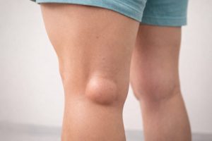 Umflătură poplitee în chistul lui Baker la nivelul genunchiului