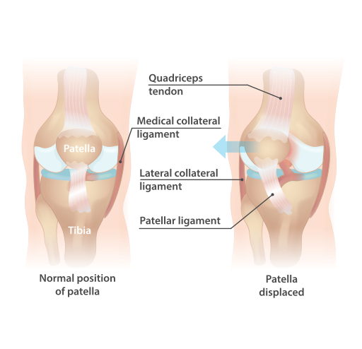 luxatie-rotula-ilustratie-anatomica.png