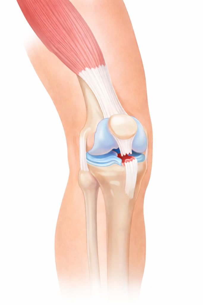 Ruptura tendonului rotulian la nivelul genunchiului – ilustrație anatomică