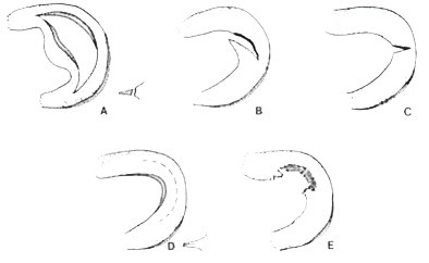 leziuni de menisc genunchi diagrama
