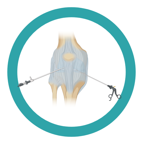 Artroscopii ortopedice