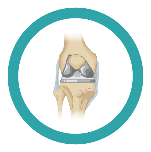 Protezare articulară