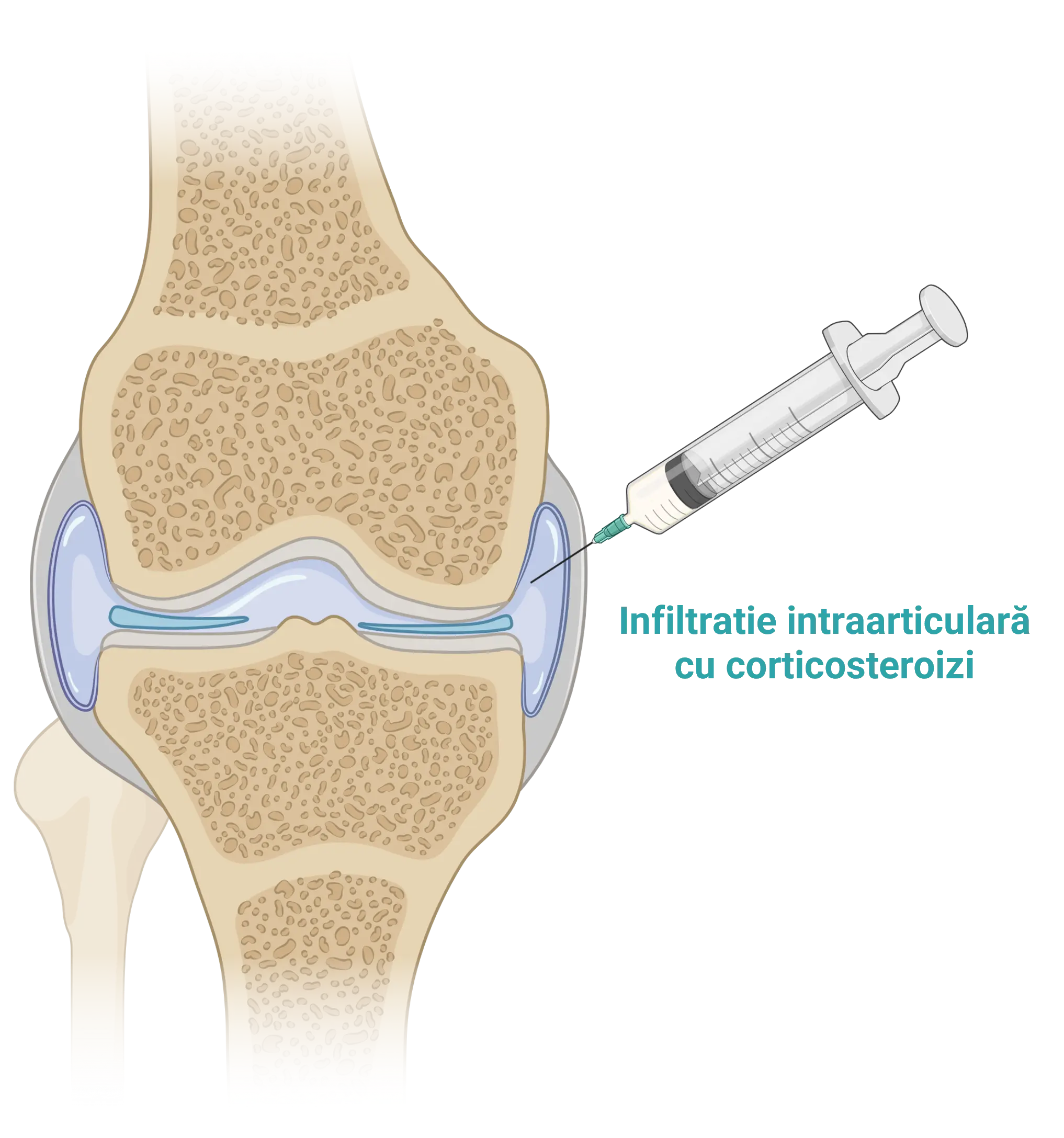 Infiltrație intraarticulară cu corticosteroizi