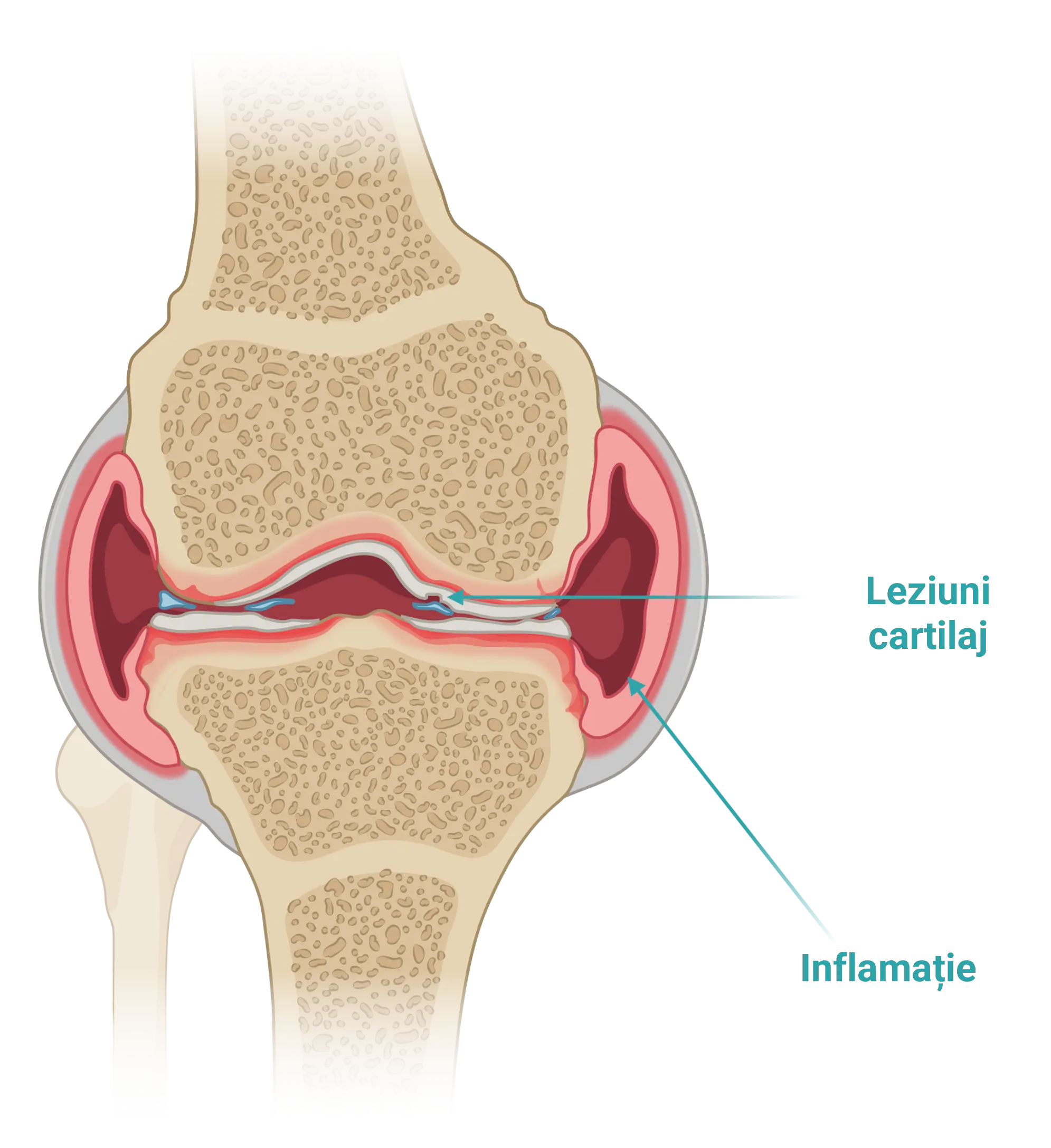 Inflamație la nivelul genunchiului