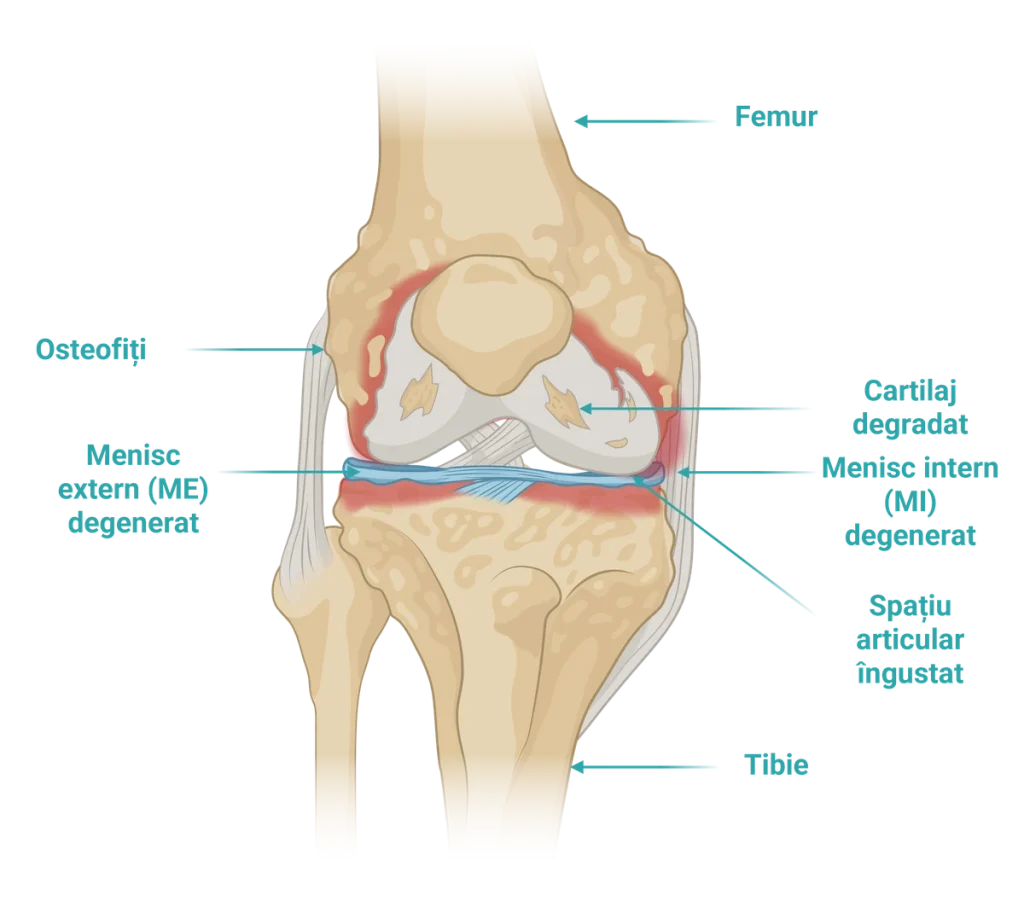 Ilustrație anatomică a unui genunchi cu gonartroză, cu osteofiți, cartilaj degradat, menisc intern și extern degenerat și spațiu articular îngustat.