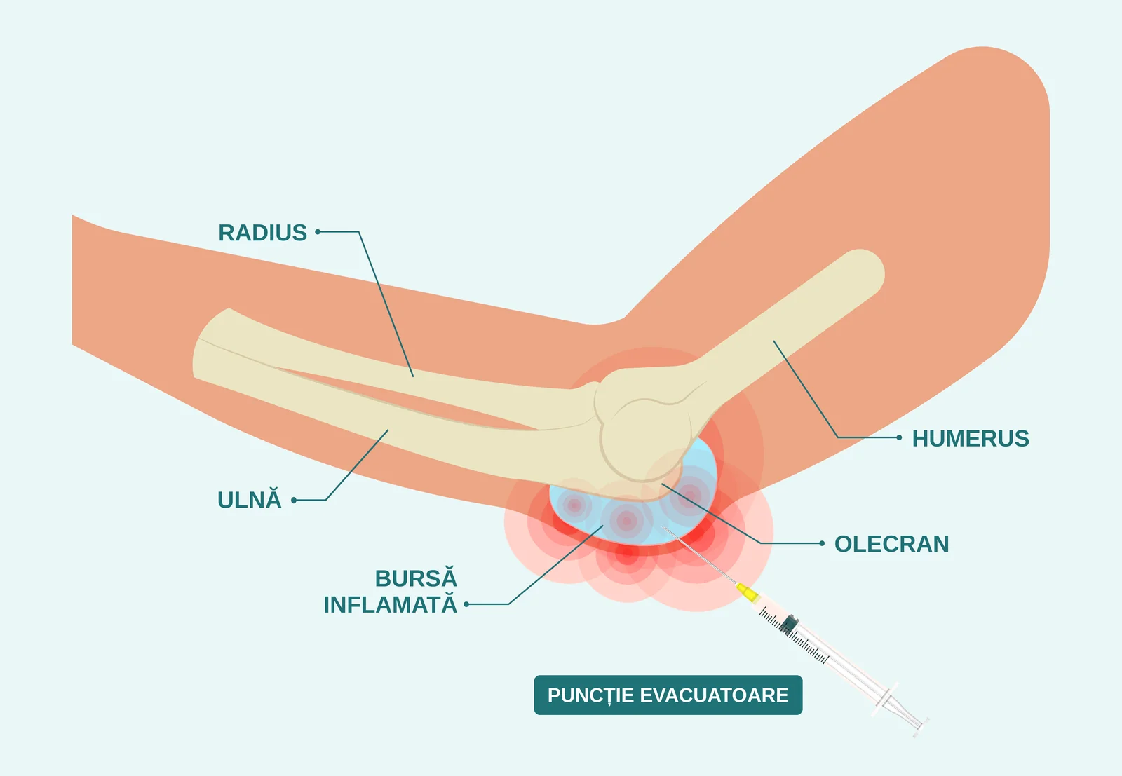 Cot îndoit, văzut din lateral: humerusul, ulna și radiusul, cu bursa destinsă între vârful olecranului și piele, zona inflamată din jur și un ac introdus în pungă.