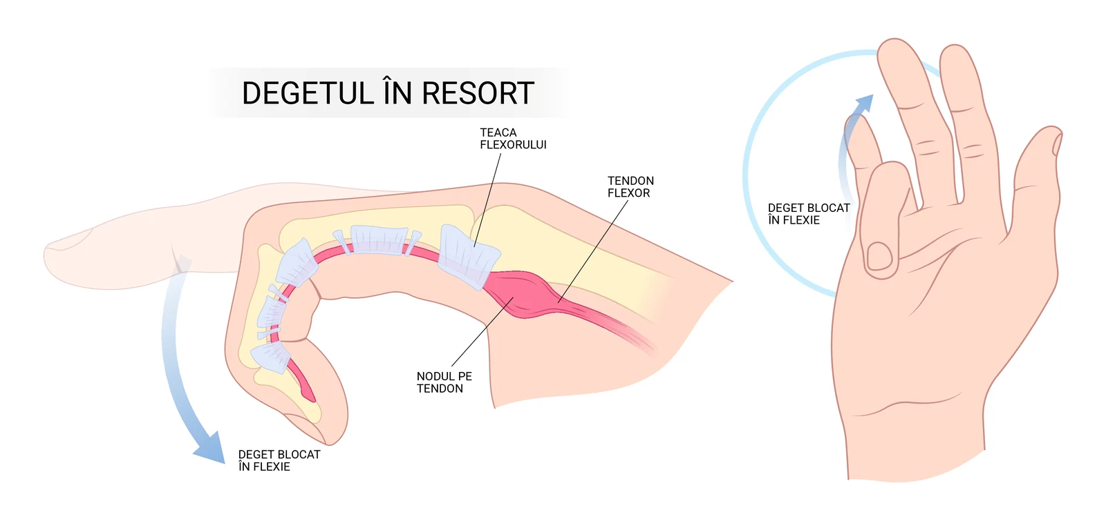 Deget în resort: secțiune prin deget cu tendonul flexor, teaca lui și nodulul care blochează alunecarea, alături de mâna cu degetul prins în flexie