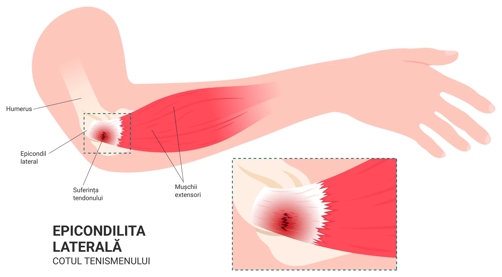 Schemă a cotului în epicondilita laterală, cunoscută ca cotul tenismenului: inserția tendoanelor extensoare pe epicondilul lateral, cu zona de suferință a tendonului marcată și detaliu mărit