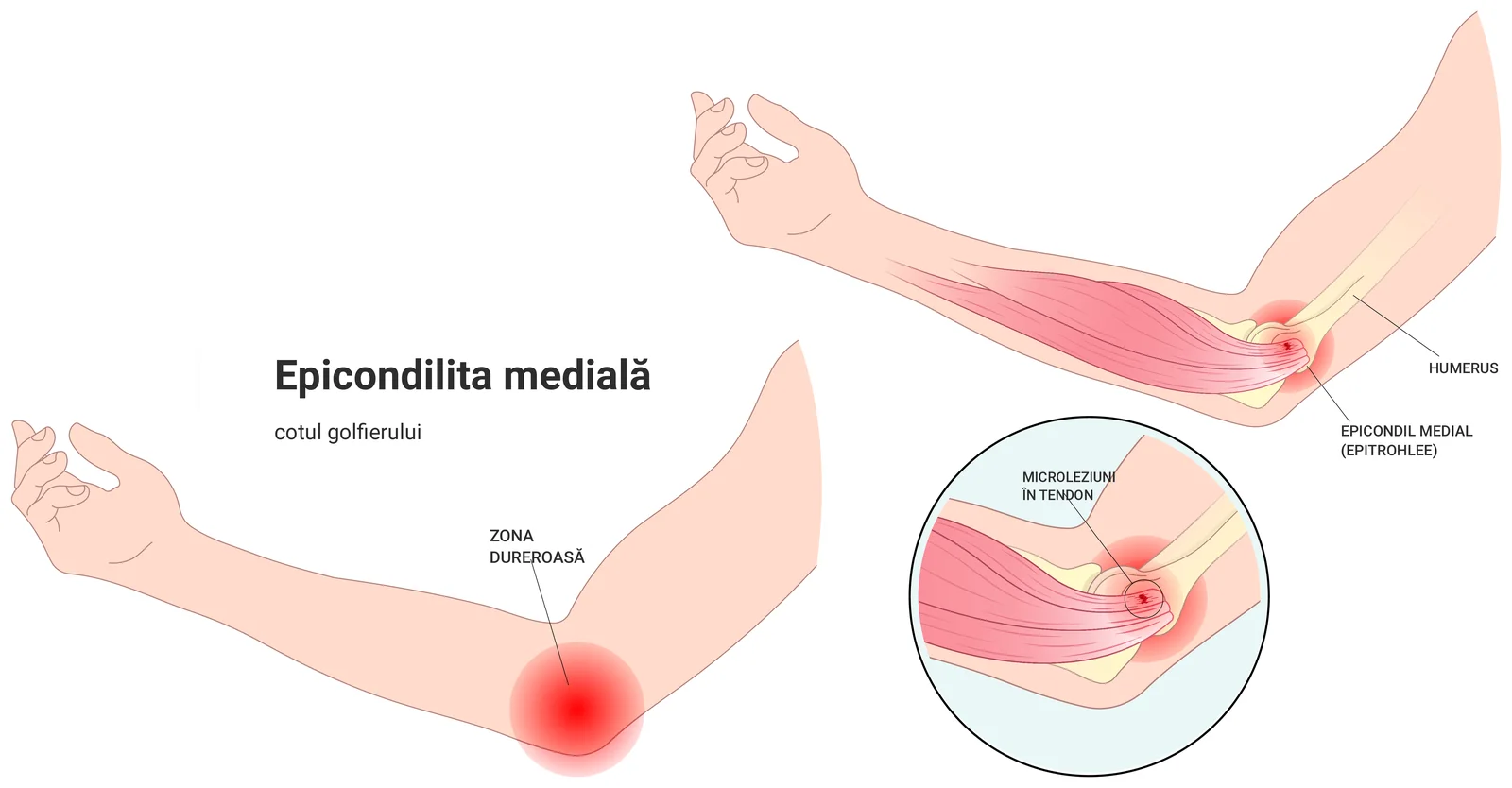 Ilustrație a epicondilitei mediale: antebrațul cu zona dureroasă pe fața internă a cotului, inserția tendoanelor flexoare pe epicondilul medial și detaliu mărit cu microleziunile din tendon