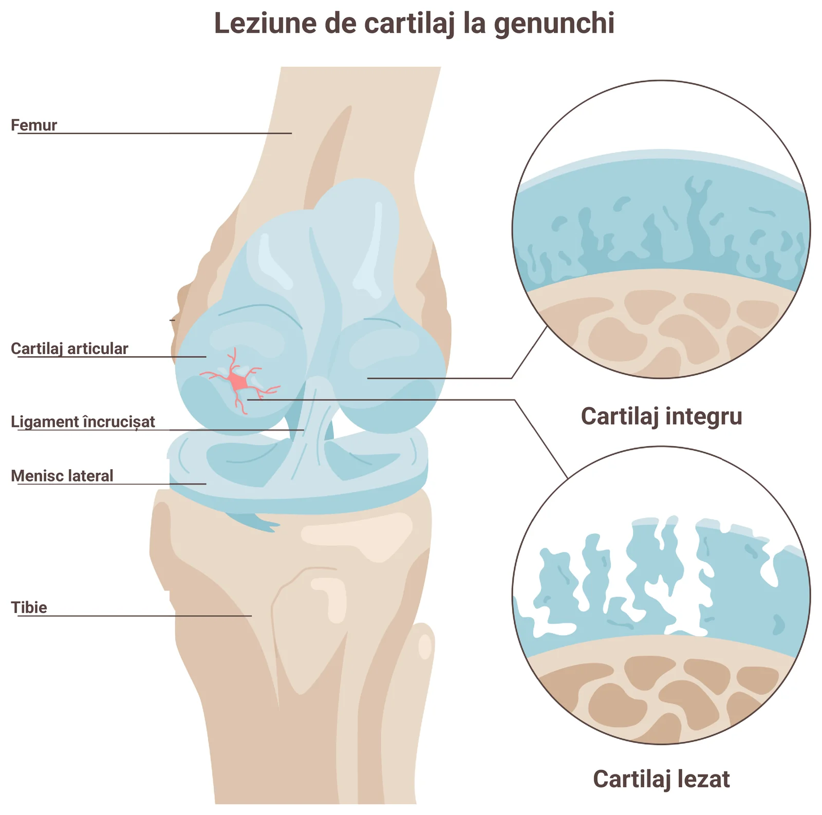 Secțiune prin genunchi cu femurul, tibia, meniscul și cartilajul articular, cu două detalii mărite: cartilaj integru și cartilaj cu defecte care ajung la os