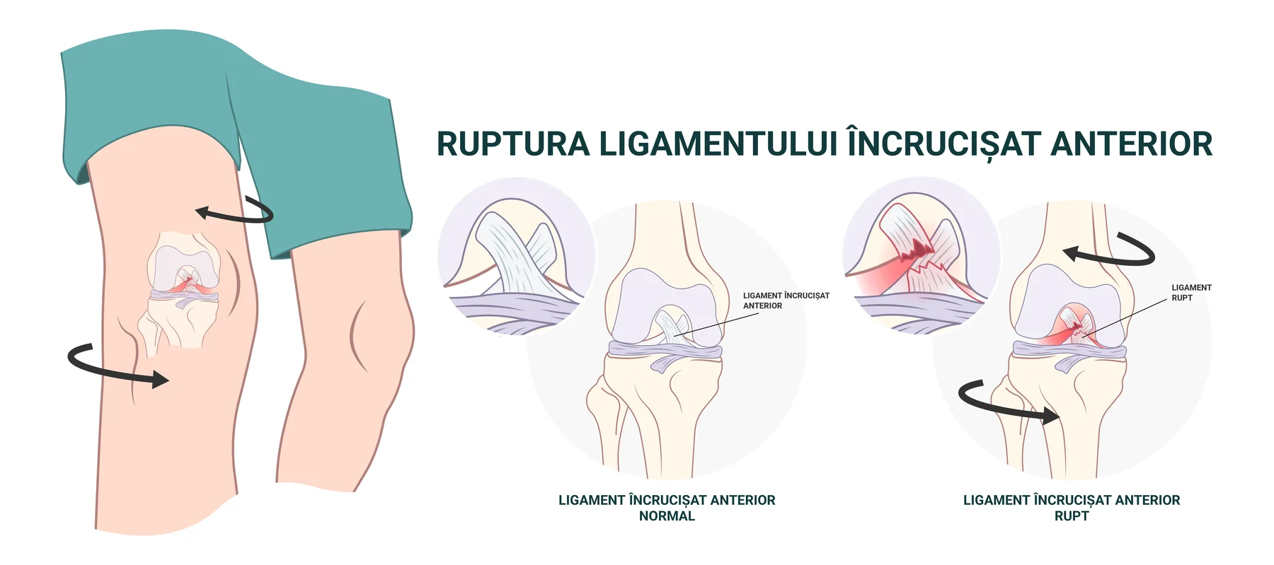 Genunchi în secțiune, cu ligamentul încrucișat anterior intact alături de același ligament rupt, și mișcarea de răsucire care produce leziunea