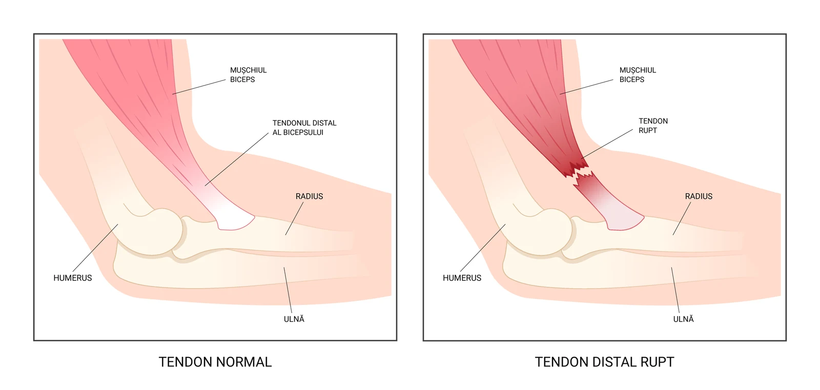 Cotul în secțiune laterală, cu tendonul distal al bicepsului intact și, alături, rupt